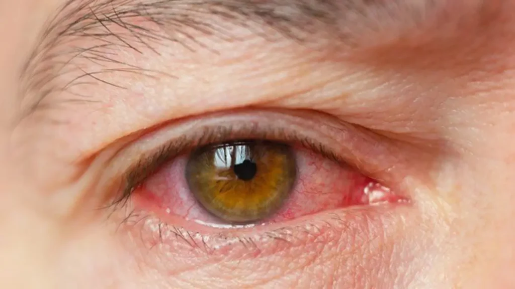 Dry Eye Disease